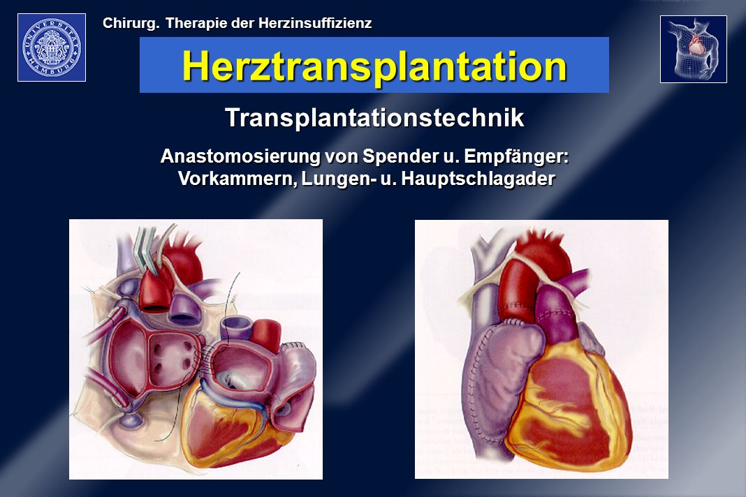Herztransplantation Transplantationstechnik