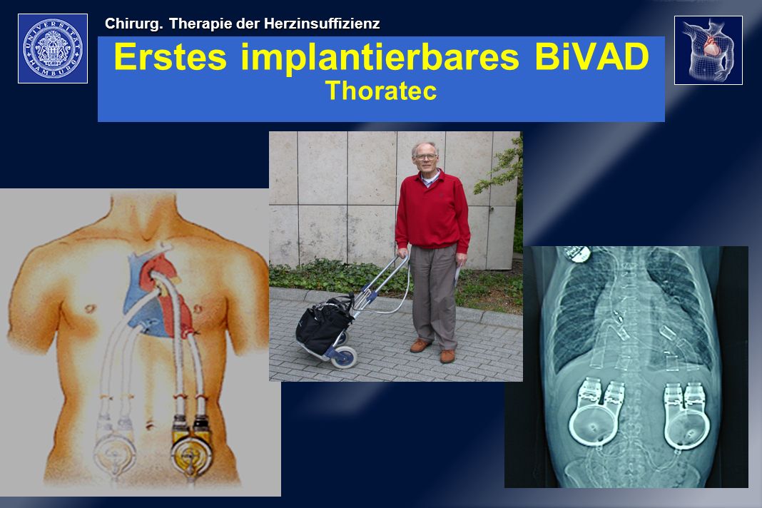Erstes implantierbares BiVAD Thoratec