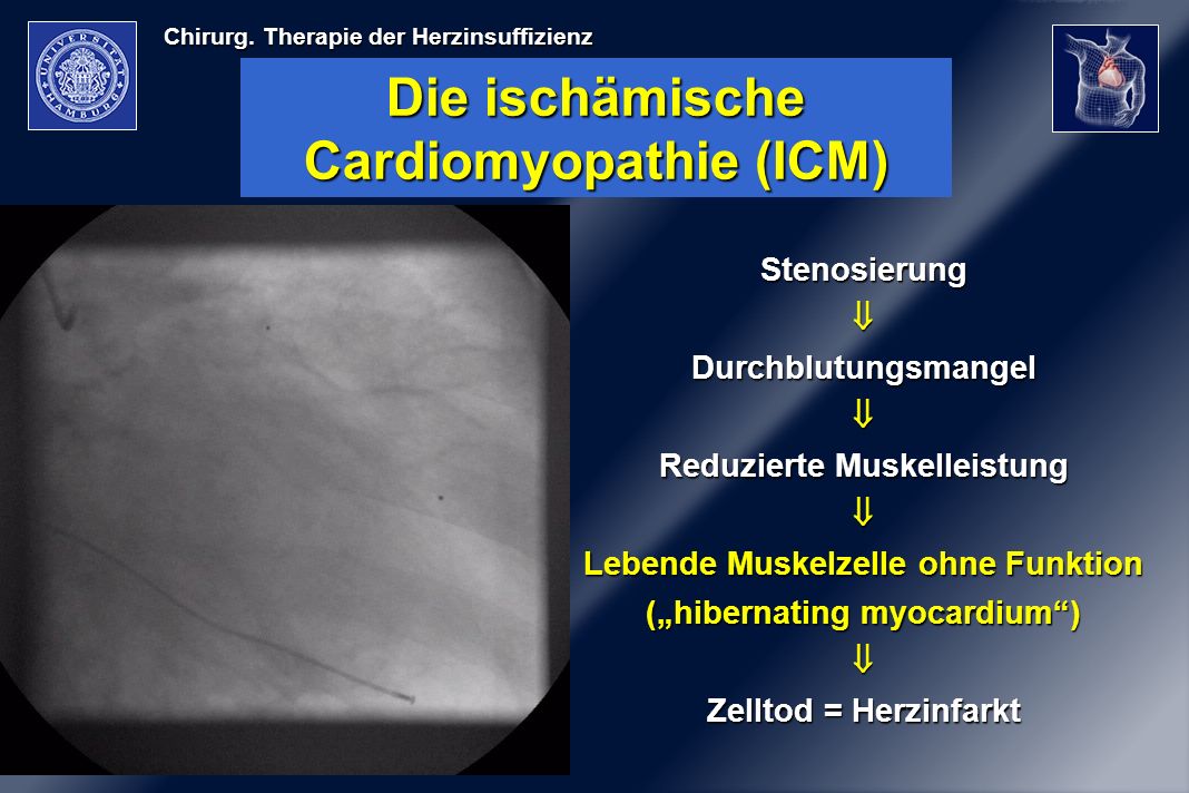 Die ischämische Cardiomyopathie (ICM)