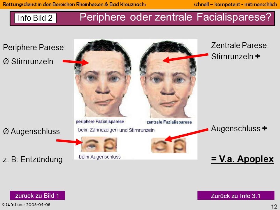 Periphere oder zentrale Facialisparese