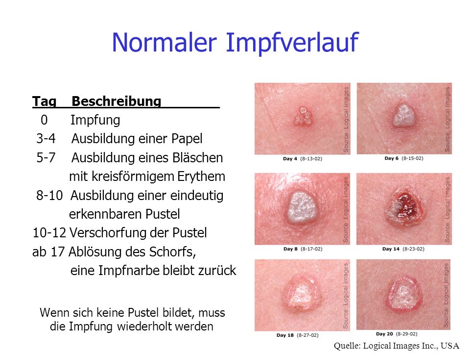 Normaler Impfverlauf Tag Beschreibung_______ 0 Impfung