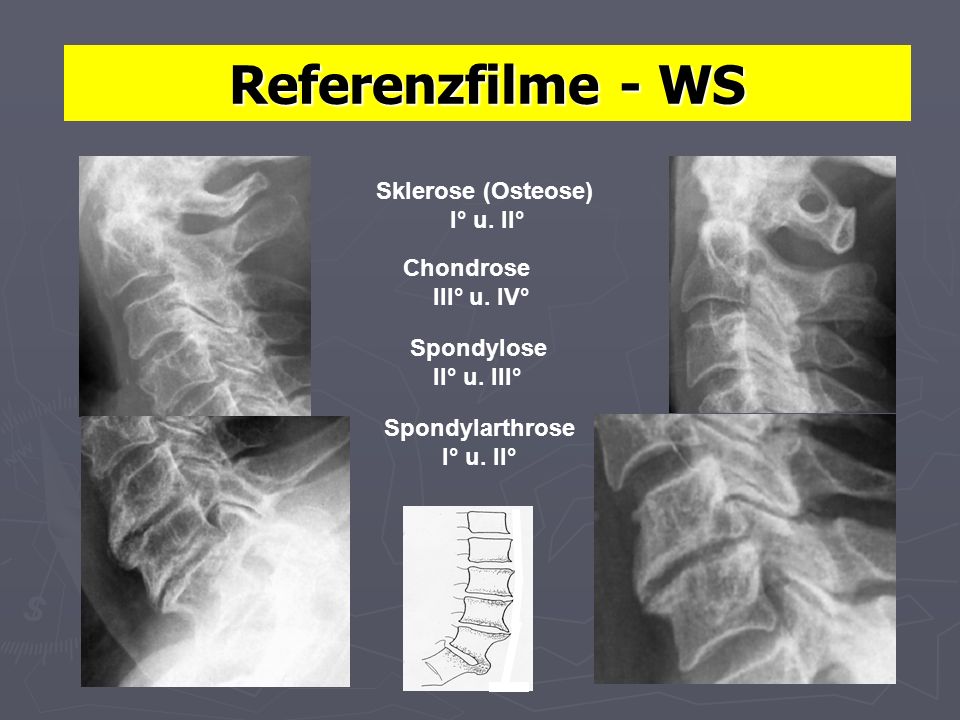 Referenzfilme - WS Sklerose (Osteose) I° u. II° Chondrose III° u. IV°