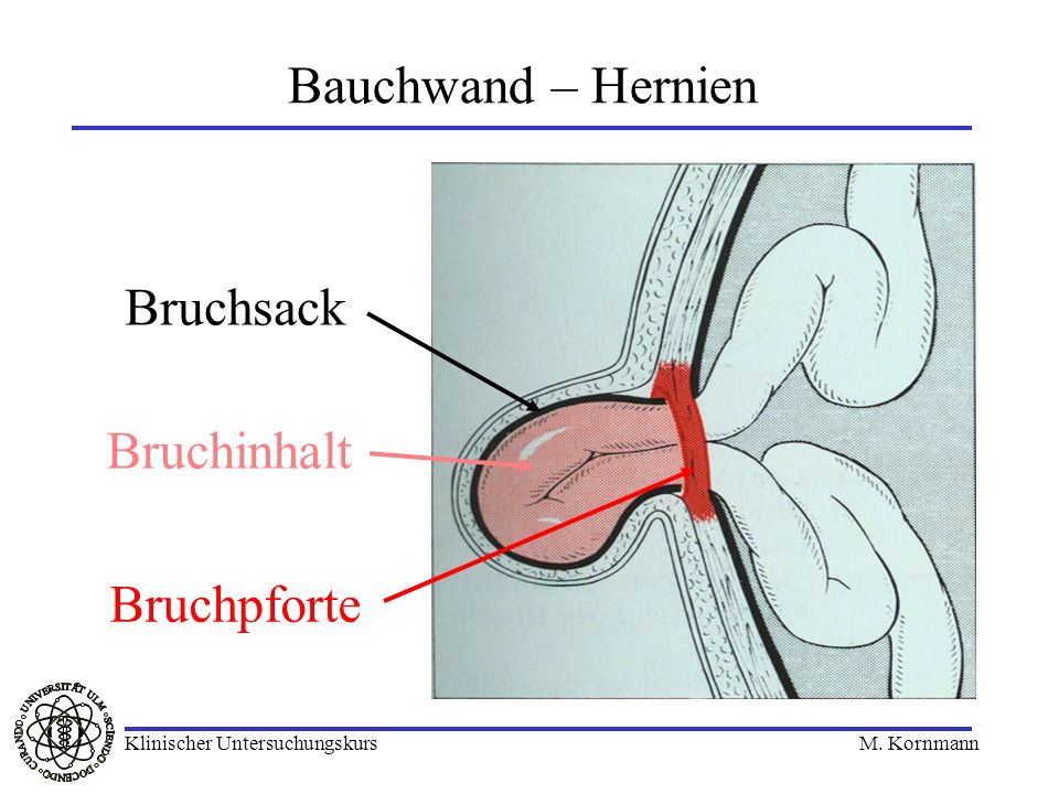 Bauchwand – Hernien Bruchsack Bruchinhalt Bruchpforte