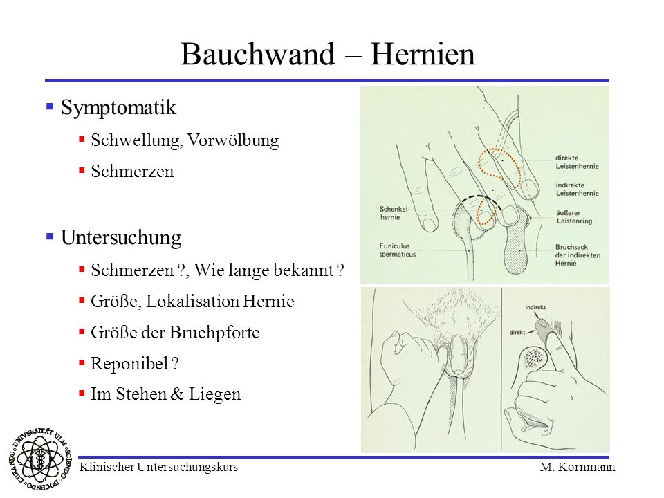 Bauchwand – Hernien Symptomatik Untersuchung Schwellung, Vorwölbung
