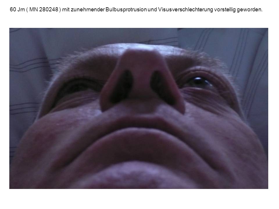 60 Jm ( MN ) mit zunehmender Bulbusprotrusion und Visusverschlechterung vorstellig geworden.