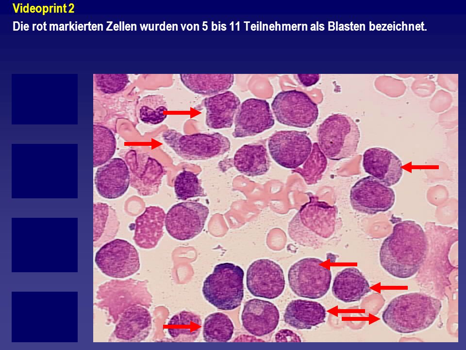 Videoprint 2 Die rot markierten Zellen wurden von 5 bis 11 Teilnehmern als Blasten bezeichnet.