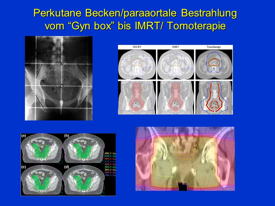 Perkutane Becken/paraaortale Bestrahlung vom Gyn box bis IMRT/ Tomoterapie