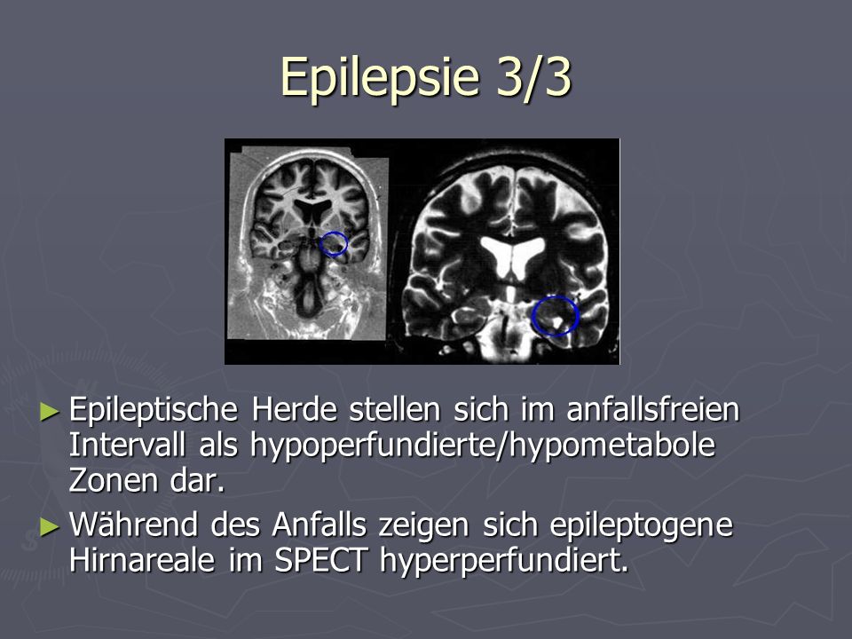 Epilepsie 3/3 Epileptische Herde stellen sich im anfallsfreien Intervall als hypoperfundierte/hypometabole Zonen dar.