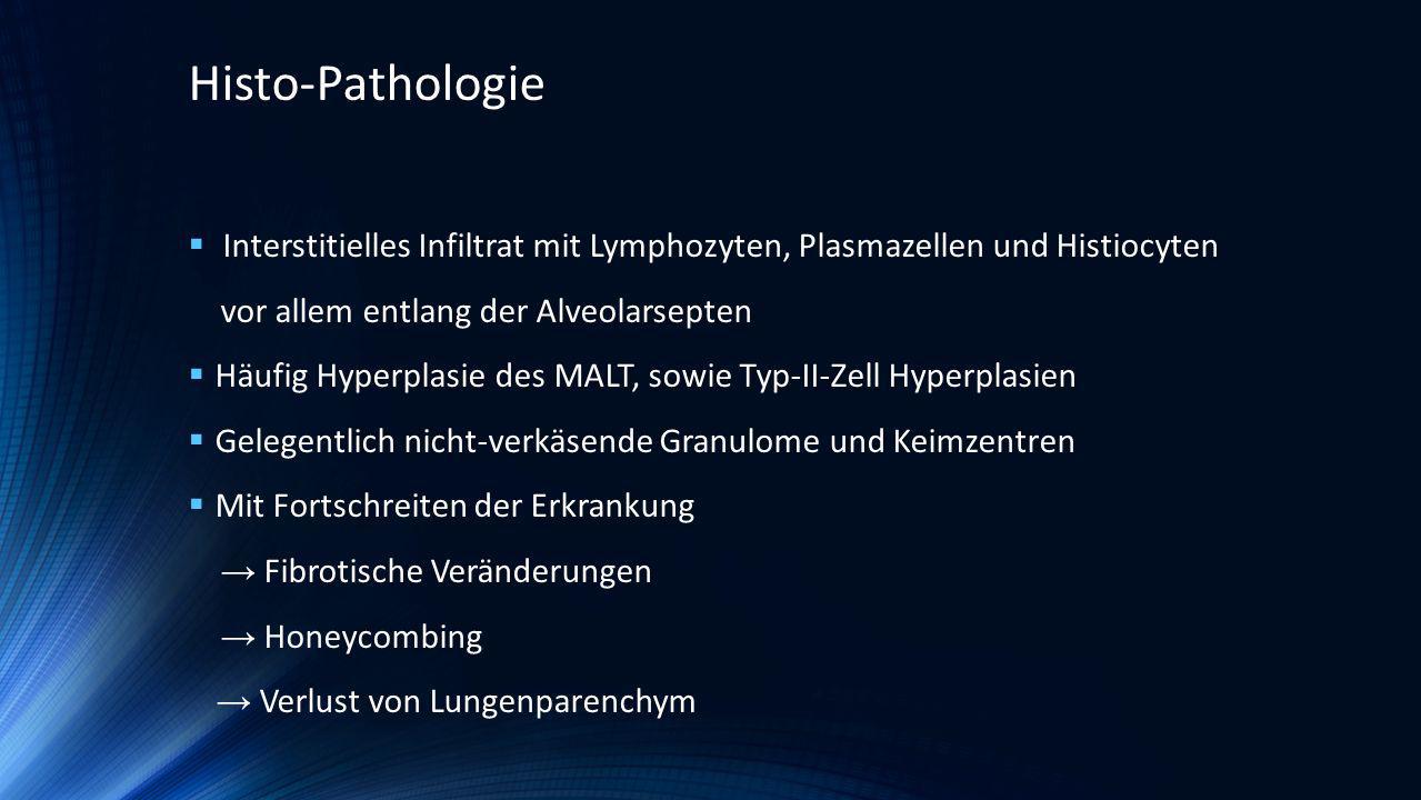 Histo-Pathologie Interstitielles Infiltrat mit Lymphozyten, Plasmazellen und Histiocyten. vor allem entlang der Alveolarsepten.