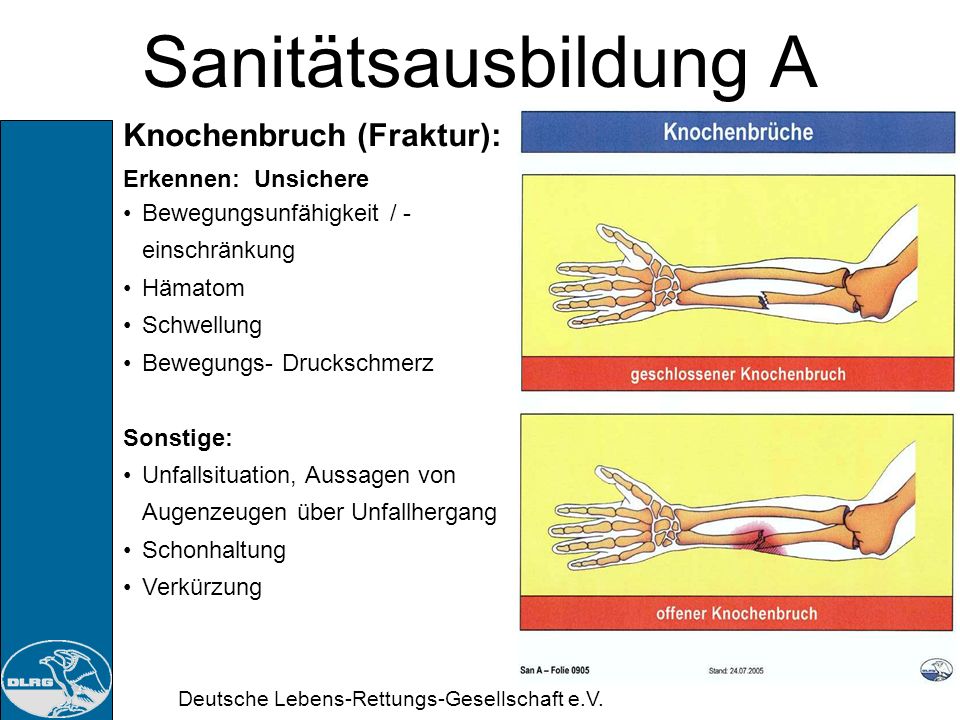 Sanitätsausbildung A Knochenbruch (Fraktur): Erkennen: Unsichere