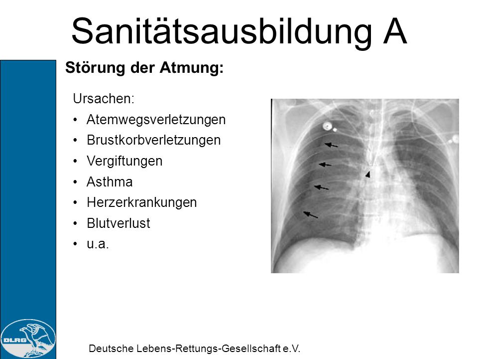 Sanitätsausbildung A Störung der Atmung: Ursachen: