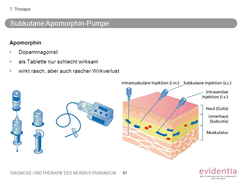 Subkutane Apomorphin-Pumpe
