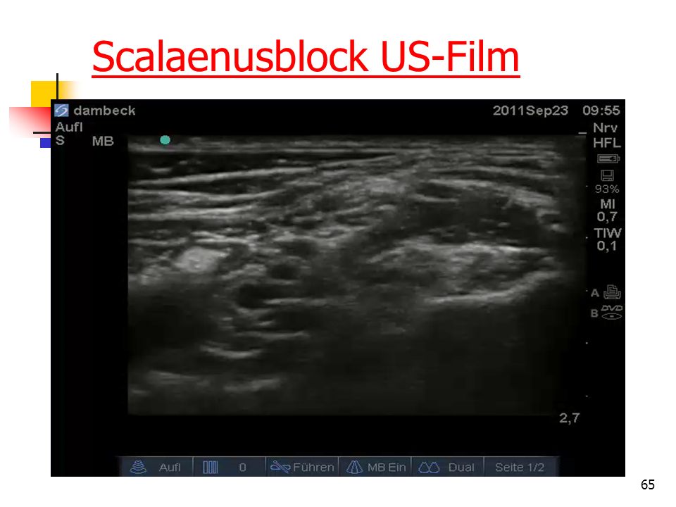 Scalaenusblock US-Film