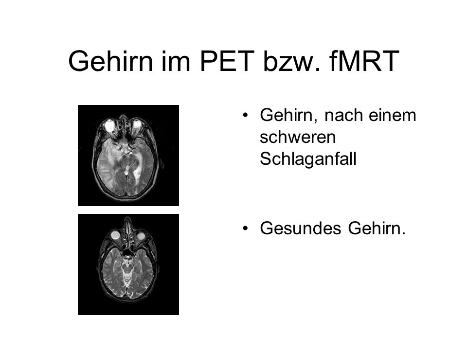 Gehirn im PET bzw. fMRT Gehirn, nach einem schweren Schlaganfall