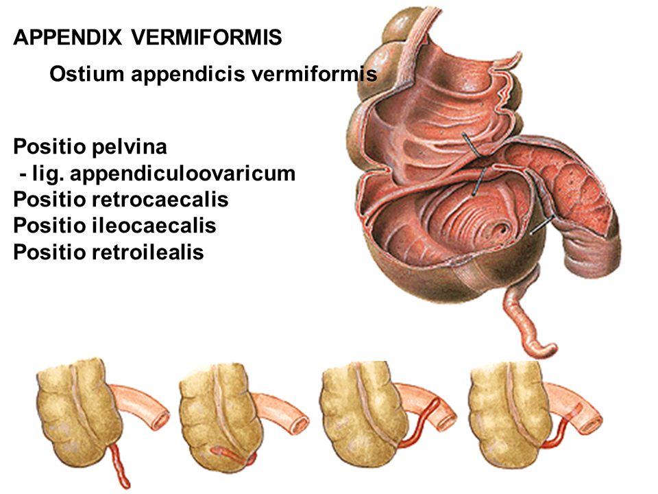 APPENDIX VERMIFORMIS Ostium appendicis vermiformis. Positio pelvina. - lig. appendiculoovaricum. Positio retrocaecalis.