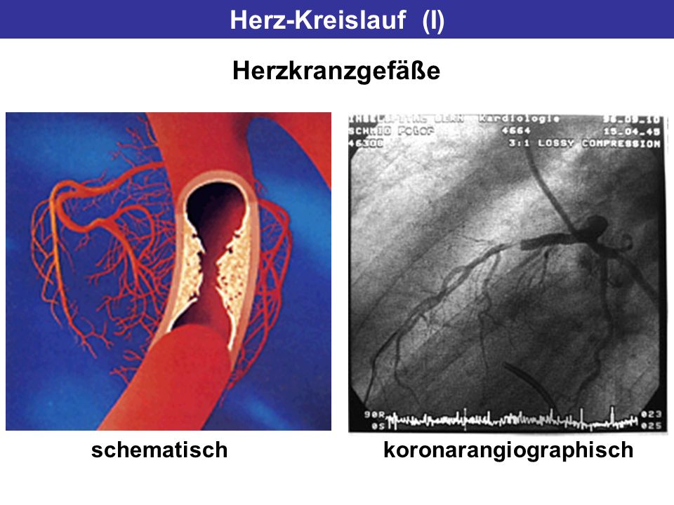Herz-Kreislauf (I) Herzkranzgefäße schematisch koronarangiographisch