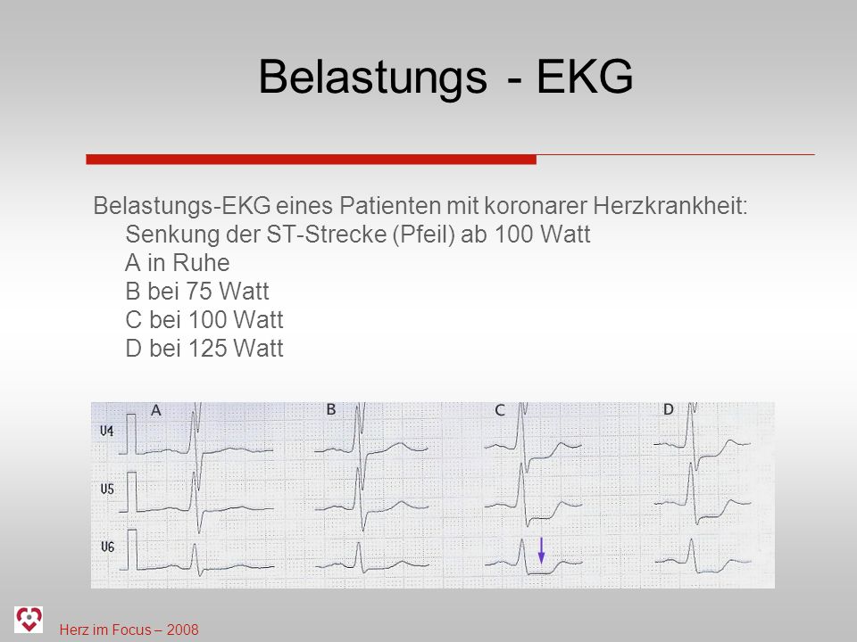 Belastungs - EKG
