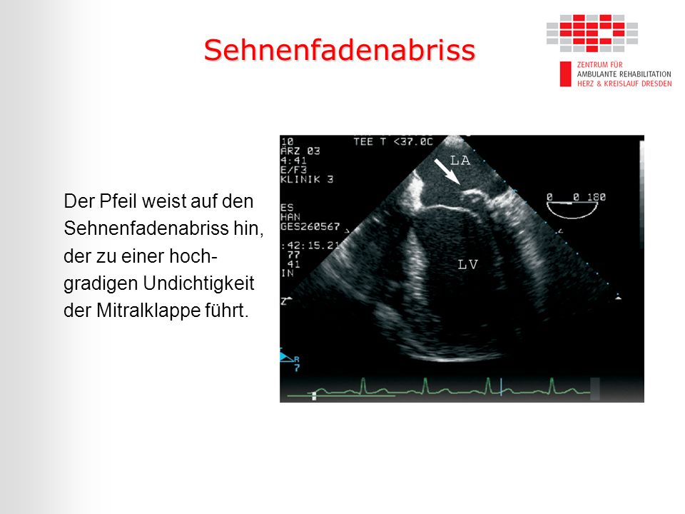 Sehnenfadenabriss Der Pfeil weist auf den Sehnenfadenabriss hin, der zu einer hoch-gradigen Undichtigkeit der Mitralklappe führt.