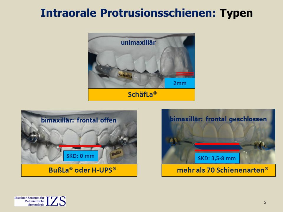 Intraorale Protrusionsschienen: Typen