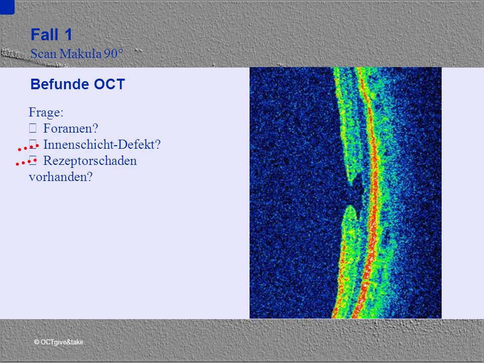 Fall 1 Befunde OCT Scan Makula 90° Frage:  Foramen