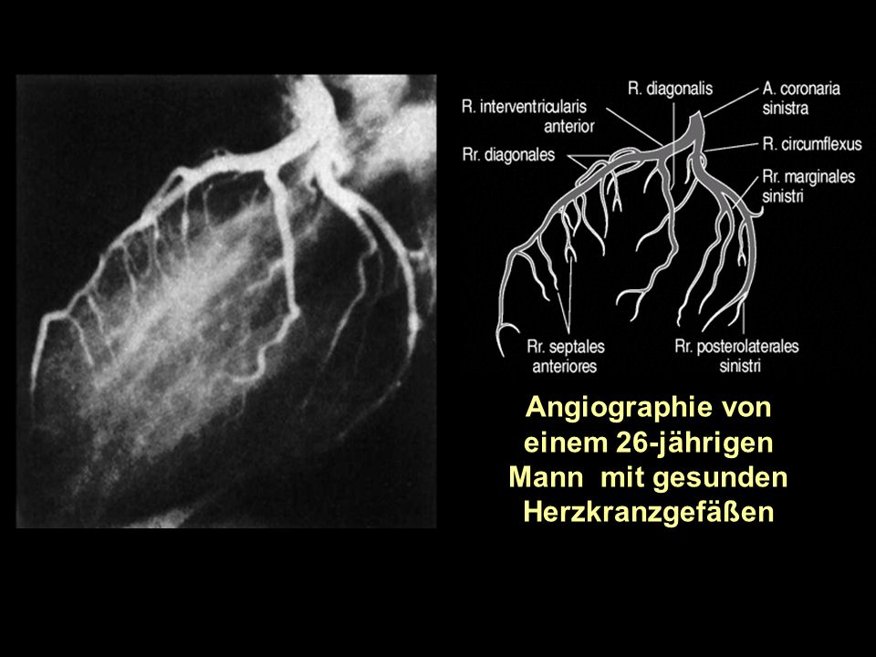 Angiographie von einem 26-jährigen Mann mit gesunden Herzkranzgefäßen