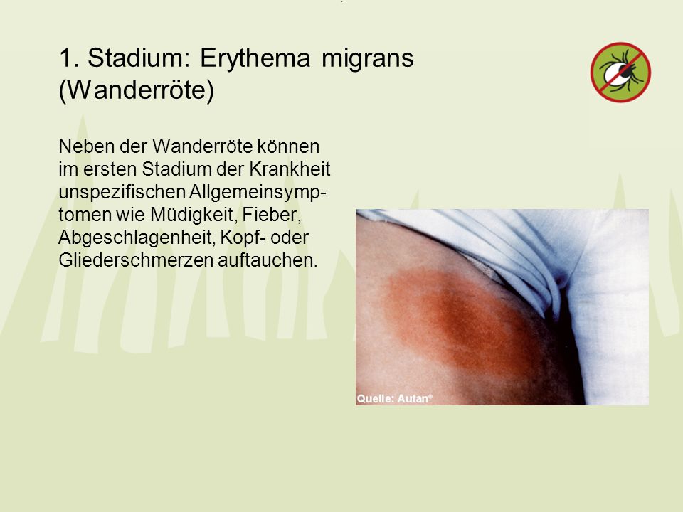 1. Stadium: Erythema migrans (Wanderröte)