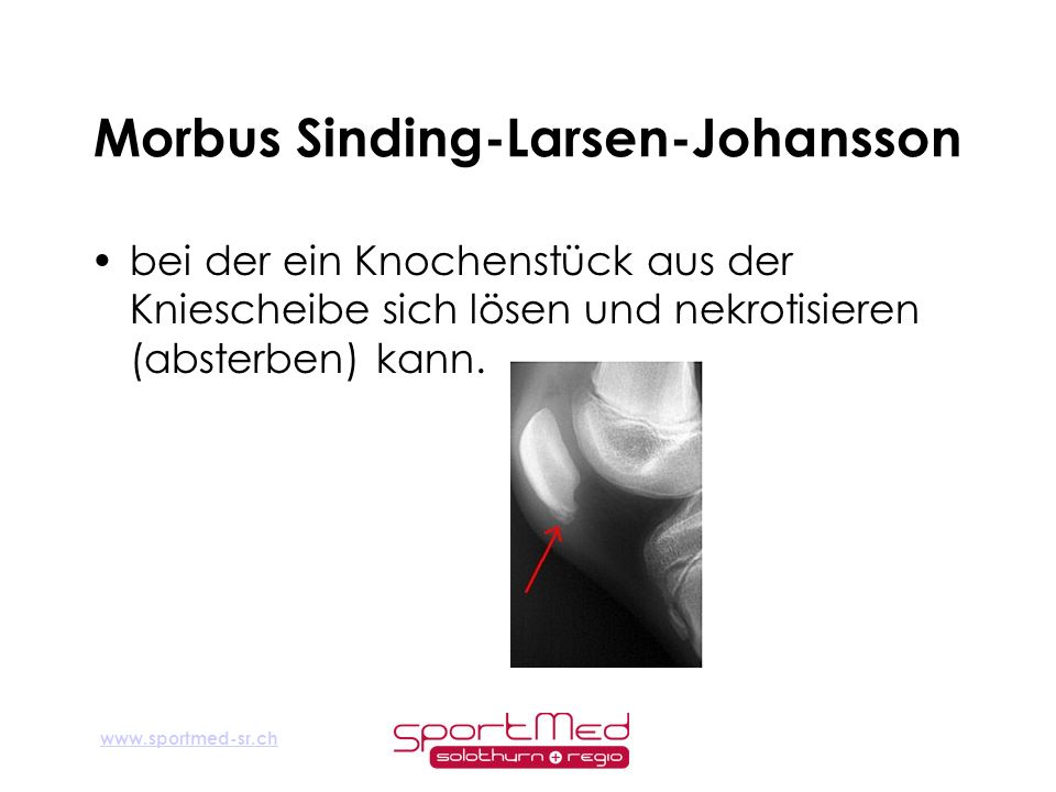 Morbus Sinding-Larsen-Johansson