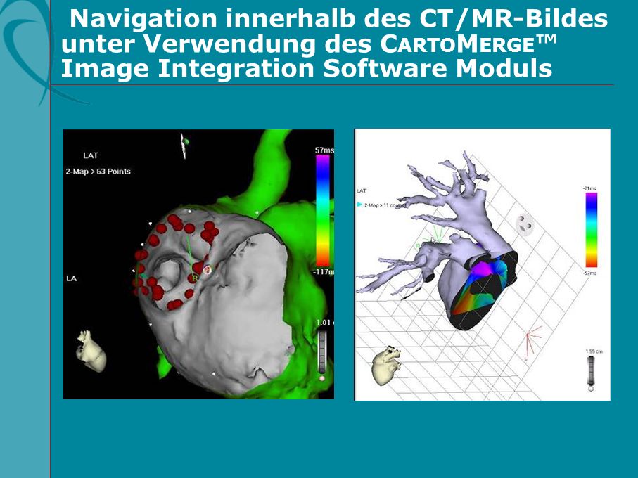 Navigation innerhalb des CT/MR-Bildes unter Verwendung des CARTOMERGE™ Image Integration Software Moduls