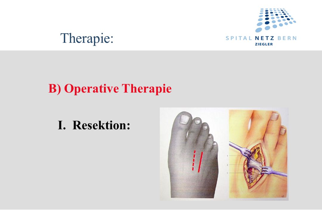 Therapie: B) Operative Therapie I. Resektion: