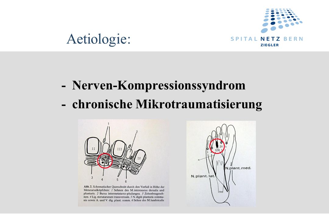 Aetiologie: - Nerven-Kompressionssyndrom