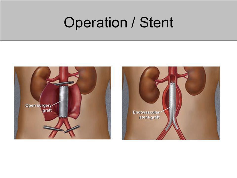 Operation / Stent