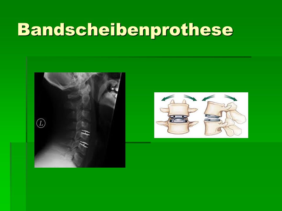 Bandscheibenprothese