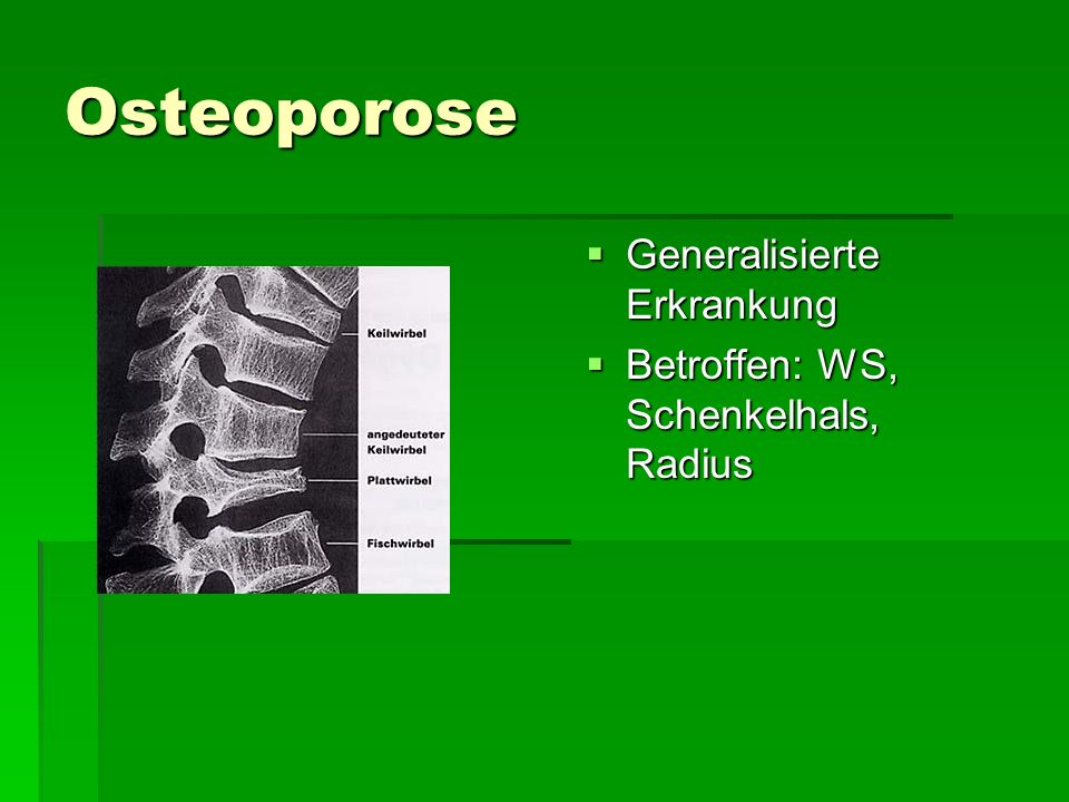 Osteoporose Generalisierte Erkrankung