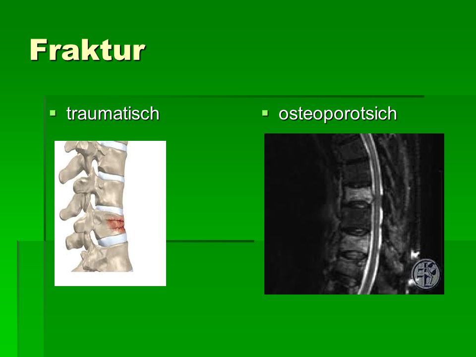 Fraktur traumatisch osteoporotsich