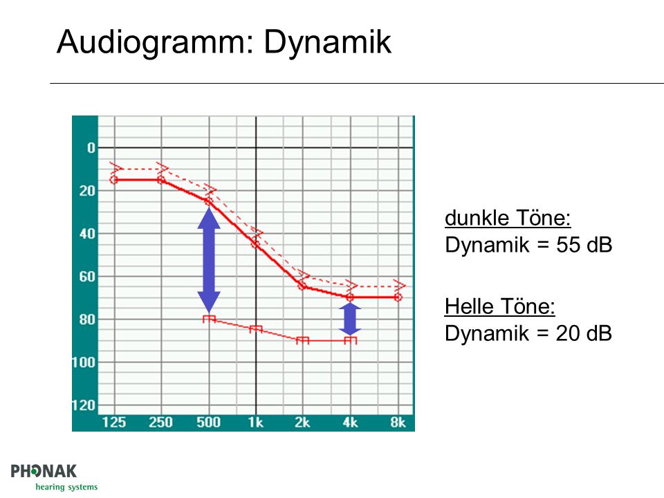 Audiogramm: Dynamik dunkle Töne: Dynamik = 55 dB Helle Töne: