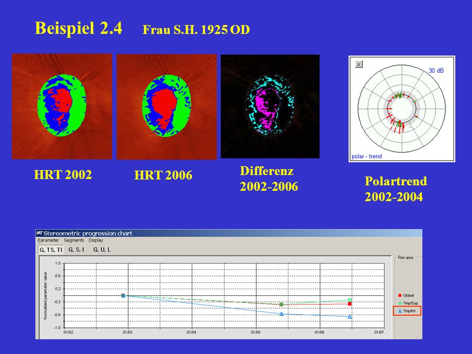 Beispiel 2.4 Frau S.H OD Differenz HRT 2002 HRT 2006
