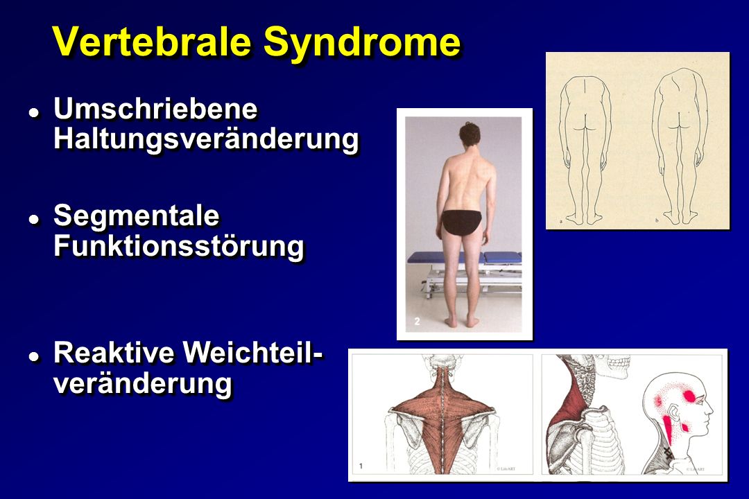 Vertebrale Syndrome Umschriebene Haltungsveränderung