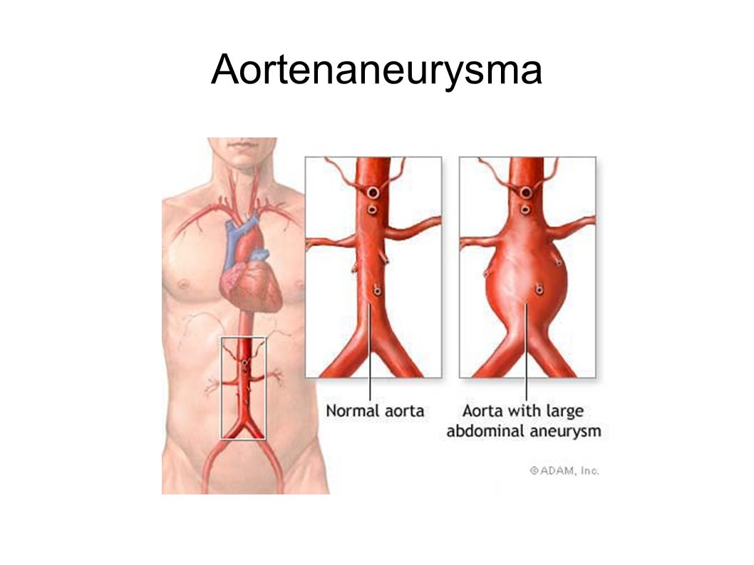 Атеросклероз брюшного. Аневризма брюшного отдела аорты супраренальная. Мешотчатая аневризма дуги аорты на кт. Инфраренальный отдел брюшной аорты аневризма. Веретенообразная аневризма инфраренального отдела аорты.