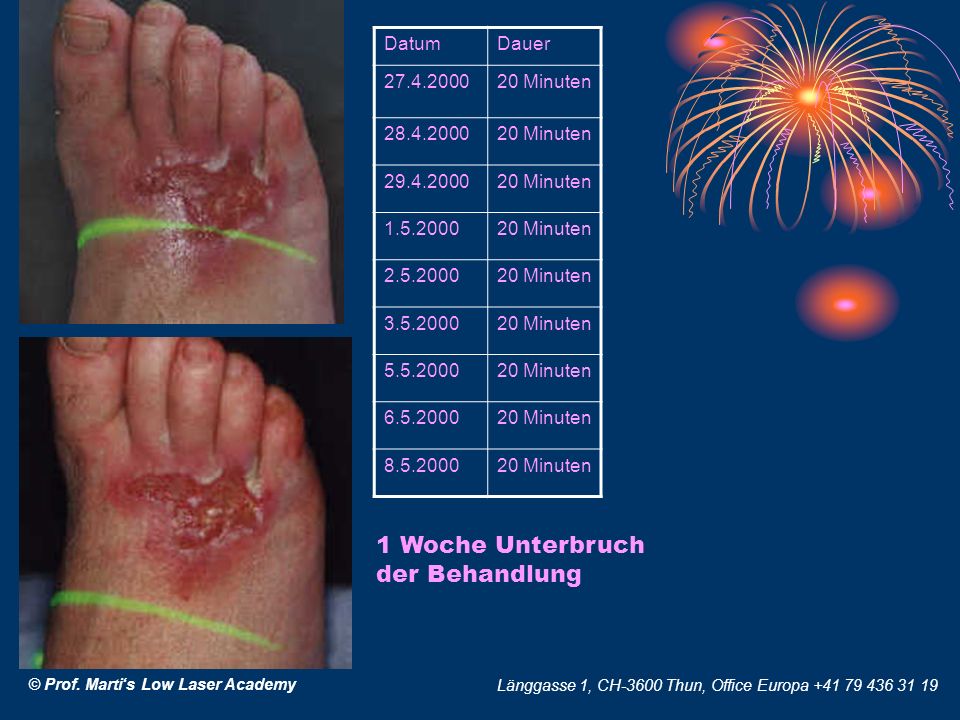 1 Woche Unterbruch der Behandlung