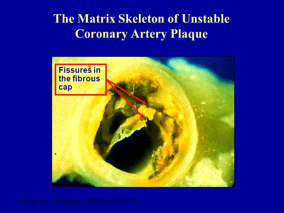 The Matrix Skeleton of Unstable Coronary Artery Plaque