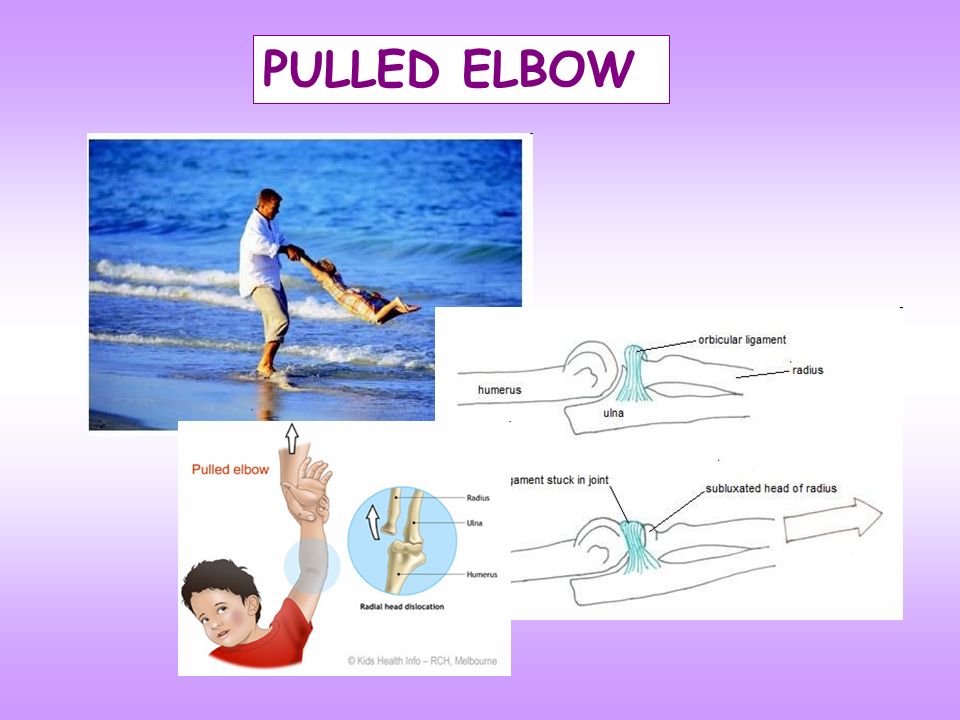 PULLED ELBOW