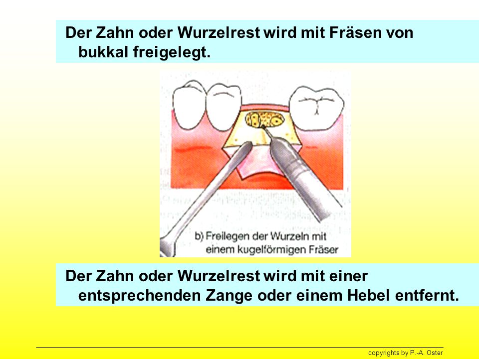 Der Zahn oder Wurzelrest wird mit Fräsen von bukkal freigelegt.